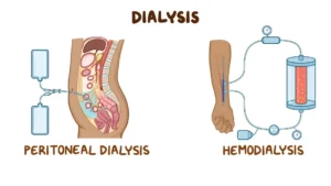 dialysis