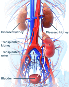 kidney transplant