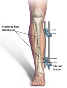 height enlargement surgery