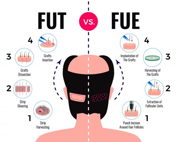 fut-vs-fue