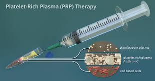 prp therapy