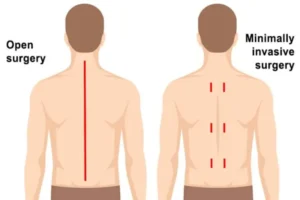 Minimally Invasive Spine Surgery