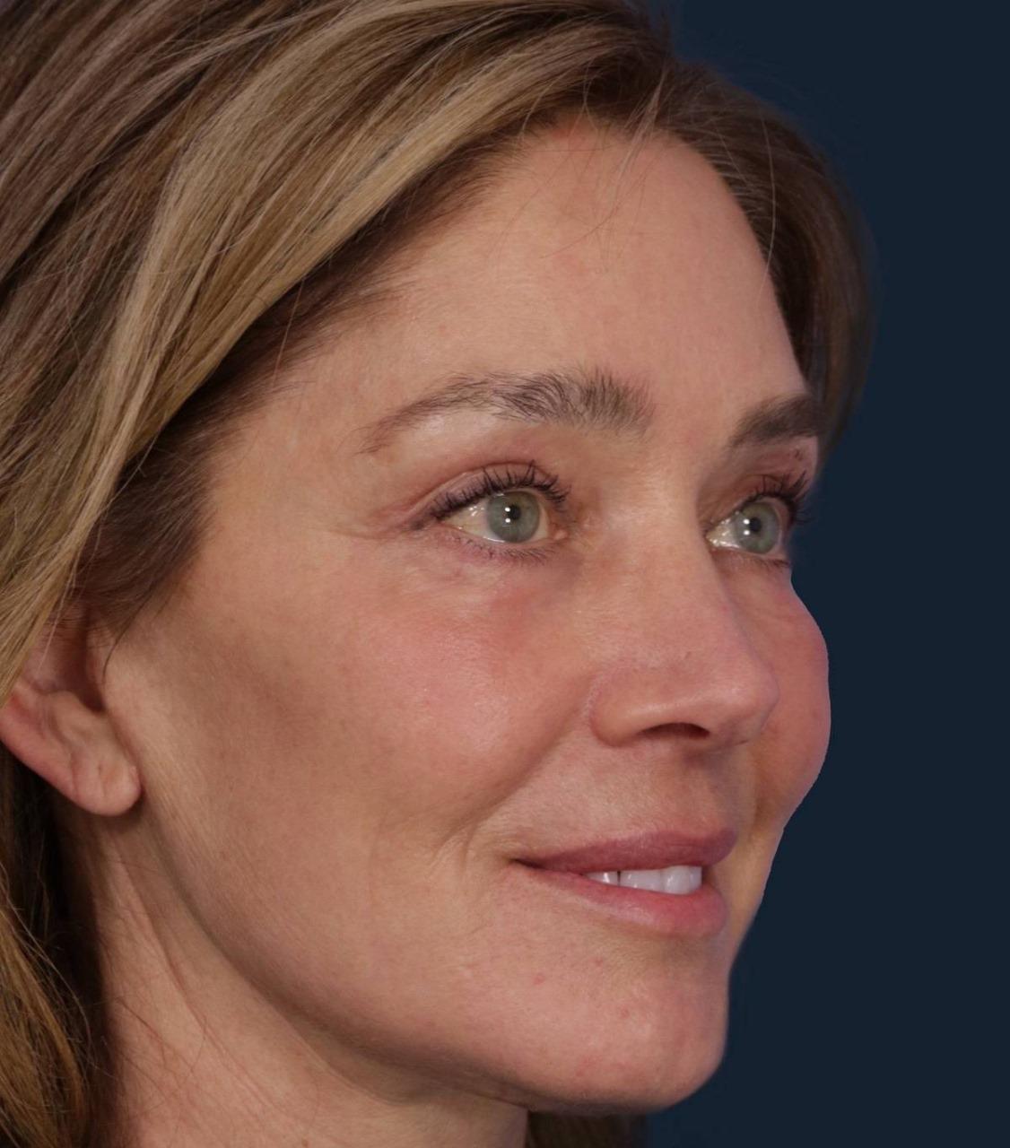Facelift Procedure
