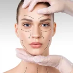 facelift
