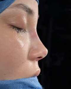 Rhinoplasty in Albania with ALBGTC MED